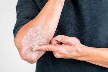 Applying the cream on the skin area damaged by psoriasis