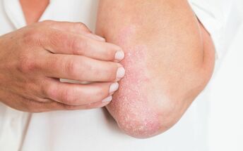 Psoriasis is accompanied by constant itching