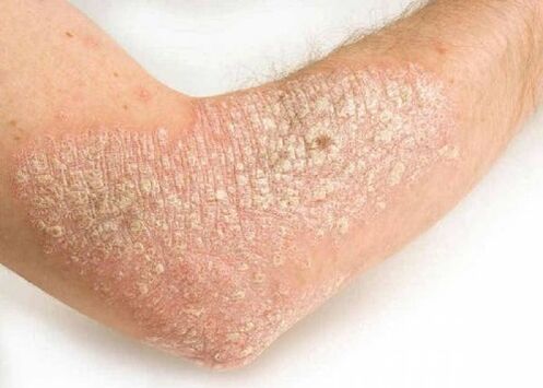 Psoriasis vulgaris on the elbow