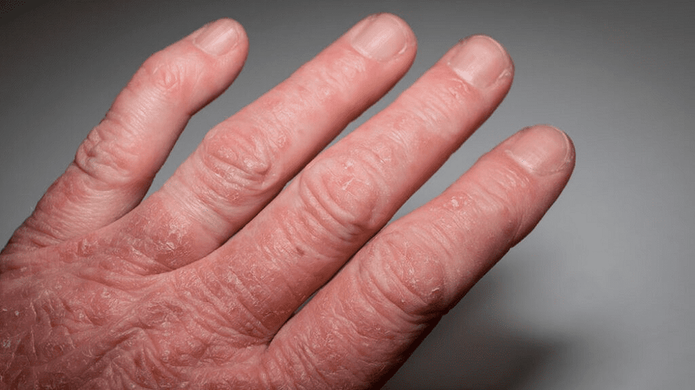 Psoriatic arthritis on the hands