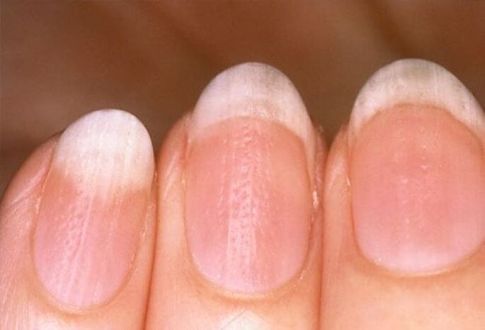 Psoriasis on nails
