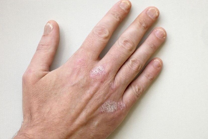 An obligatory symptom of psoriasis is plaques with scales on the skin