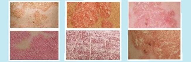 Rashes characteristic of different types of psoriasis