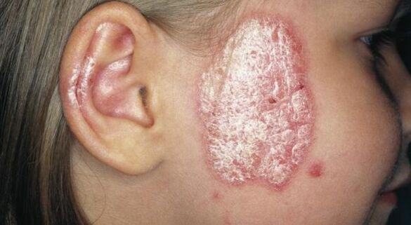 Psoriasis plaque on the face