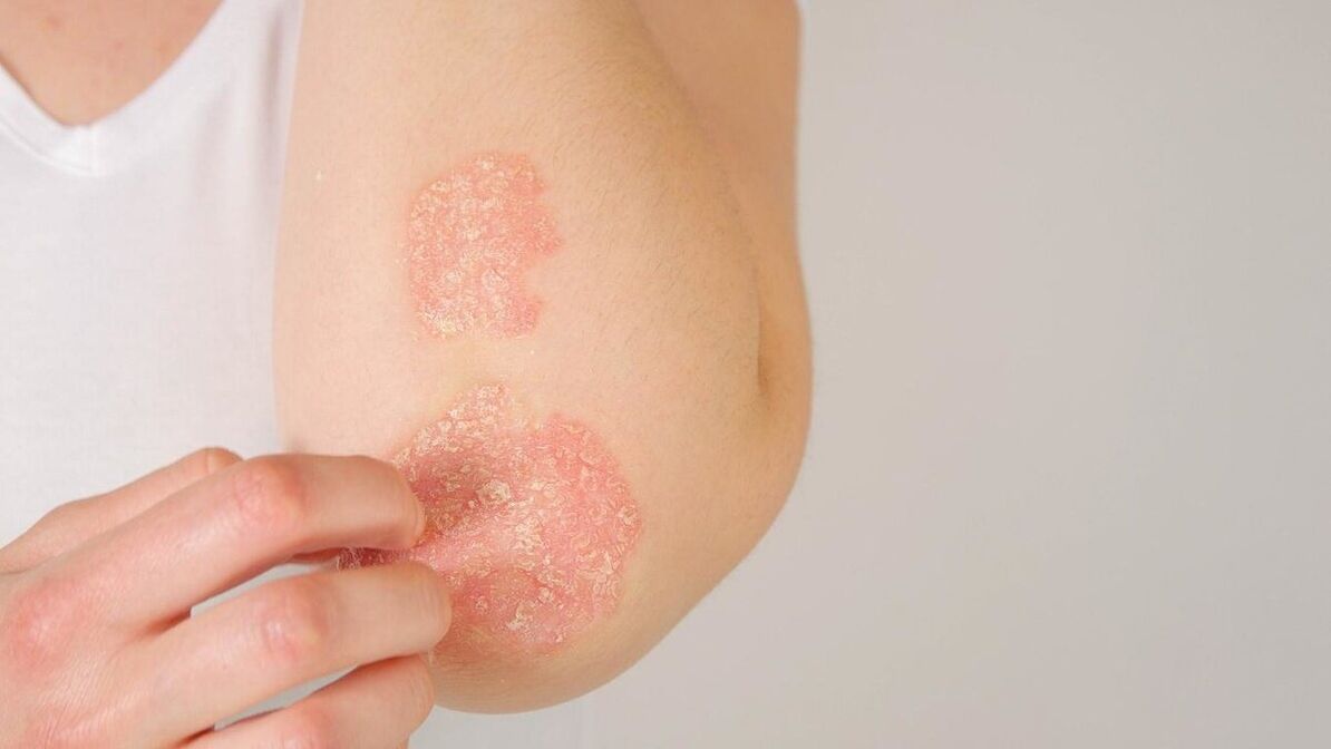 Psoriasis plaques on the elbows