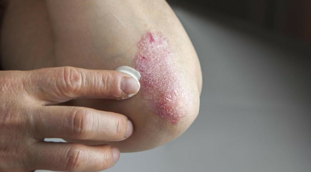 Psoriasis, which affects the skin and whose treatment involves the use of ointments