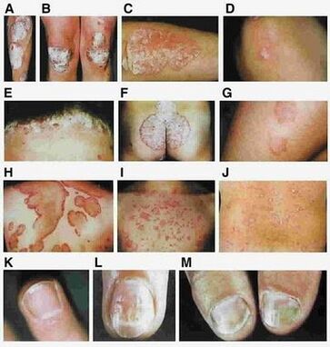 Signs of psoriasis depend on the type of disease