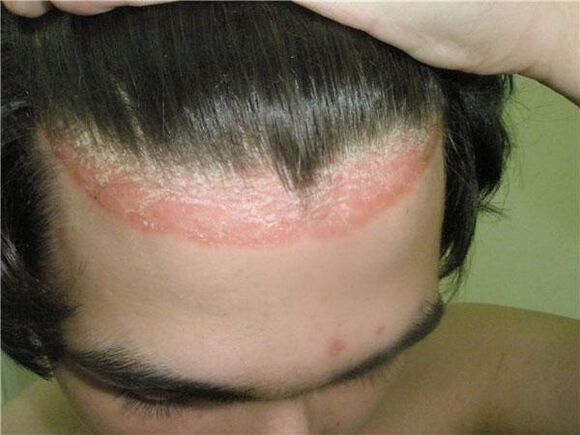 Manifestations of scalp psoriasis