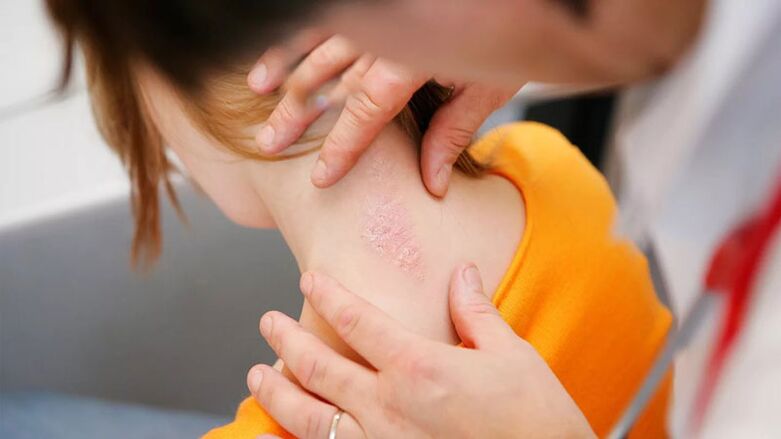 Scales and plaques from psoriasis on the neck