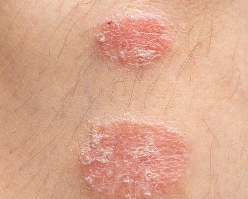 Appearance of psoriasis plaques