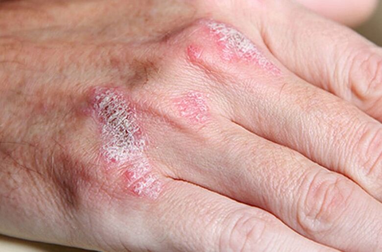 Ladomarly needs of psoriasis
