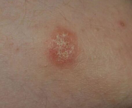 Psoriasis spot