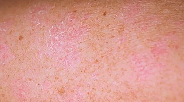 The regressive stage of psoriasis