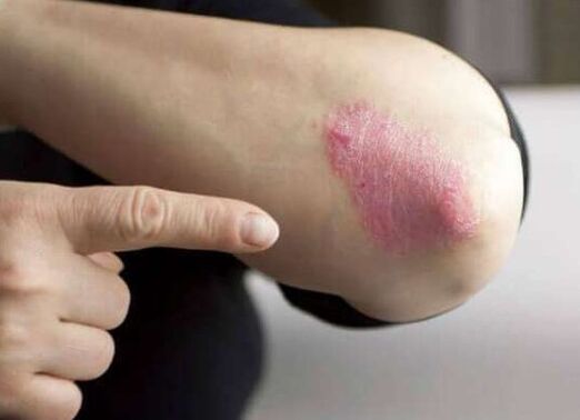 The stationary level of psoriasis