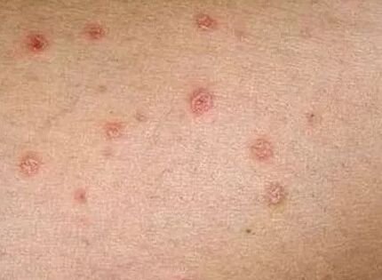 Psoriasis of the initial stage