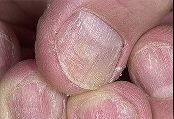 Psoriasis of nails