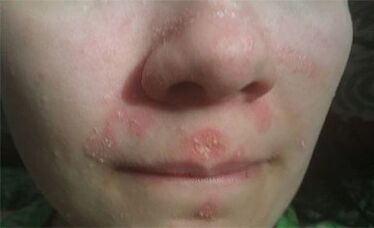 Psoriasis on the face