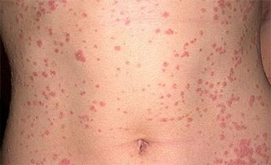 Psoriasis on the body