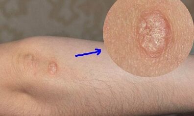 Stages of psoriasis development