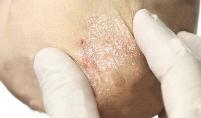 Treatment of psoriasis in the attenuation stage