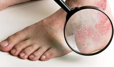 Ways to treat psoriasis