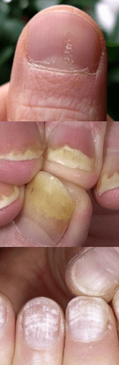 Nail psoriasis - initial stages