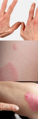 Psoriasis of the initial phase in the hands