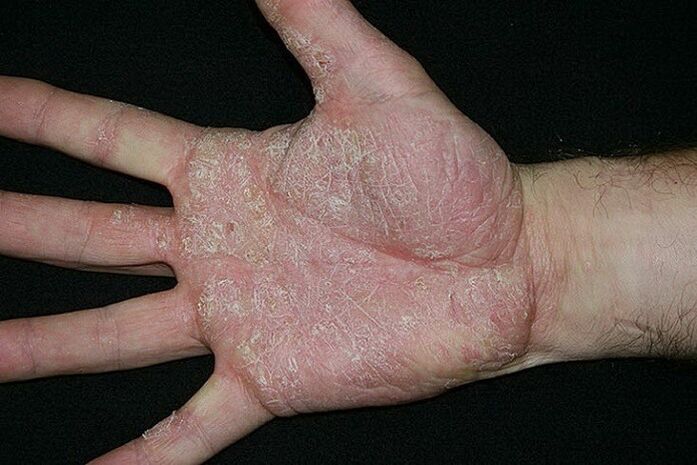 Psoriasis of the palms and feet