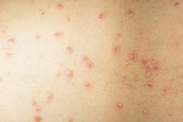 Symptoms of patchy psoriasis