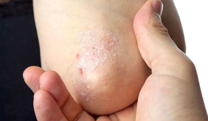 Symptoms of psoriasis in the early stages