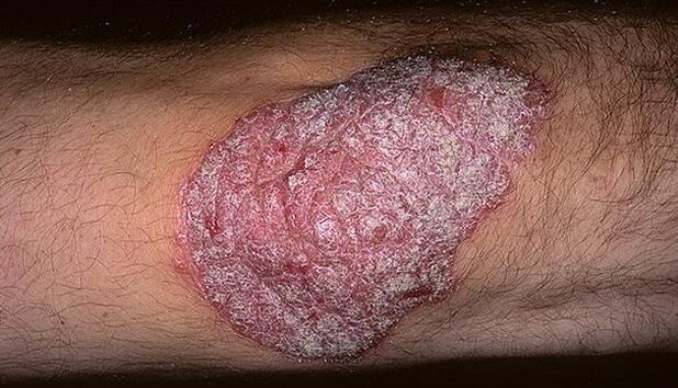 psoriasis