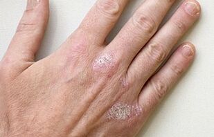 Symptoms of the initial stage of psoriasis