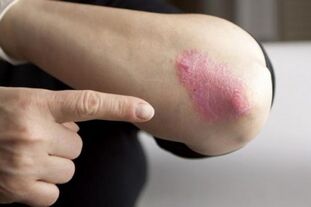 Psoriasis on the elbows