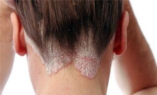 Forms and stages of the development of psoriasis