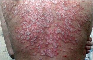 Treatment methods for psoriasis