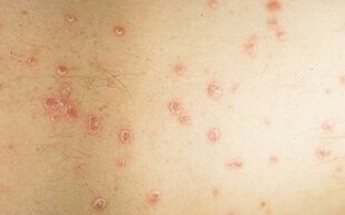 Photo of the initial stage of psoriasis