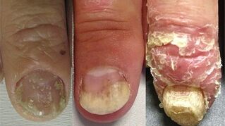 Developmental stages of nail psoriasis